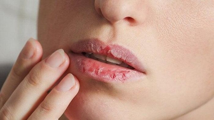 Môi sau phun xăm thường rất khô, nếu không dưỡng ẩm đầy đủ sẽ đẩy nhanh quá trình bong vảy.
