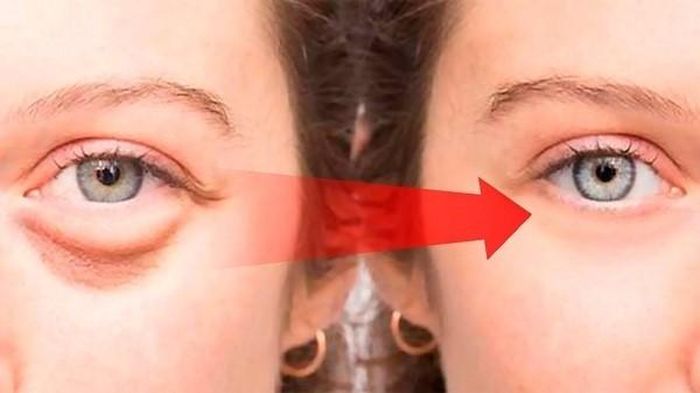 Khi massage đúng cách sẽ giúp xóa bỏ bọng mắt.