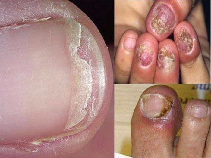 Nếu nấm móng nặng, kéo dài sẽ rất khó điều trị và móng sẽ khó trở lại hình dáng ban đầu.