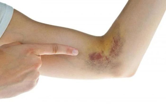 Khoai sọ giảm sưng đau, phù nề, bầm tím...