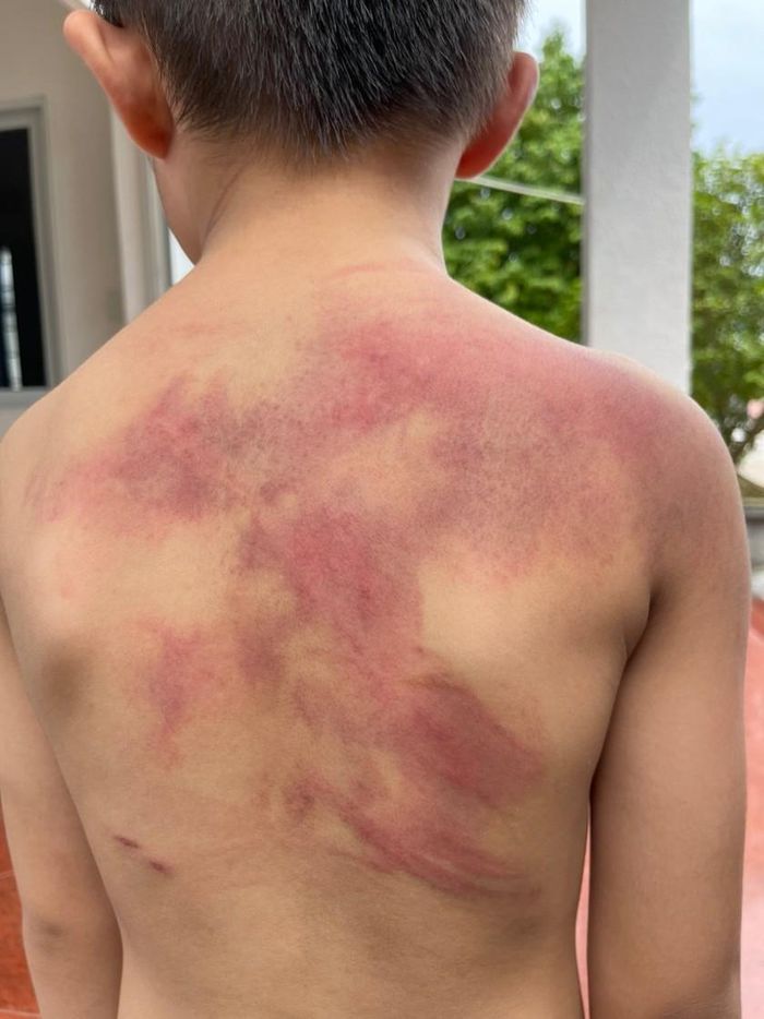 Cháu Đ. bị nhiều vết bầm trện cơ thể do cha ruột đánh