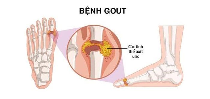  Bên cạnh đó, tình trạng thừa cân béo phì, không kiểm soát được cân nặng cũng khiến nguy cơ acid uric tăng. 