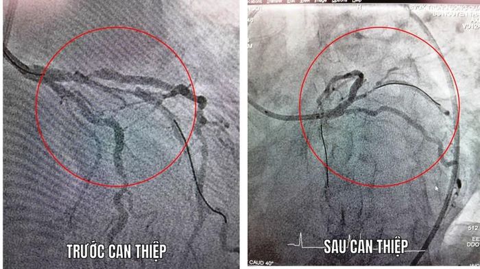Hình ảnh mạch máu tim trước của người bệnh bị hẹp bán tắc LAD và sau can thiệp đặt 1 stent vào đoạn hẹp động mạch liên thất trước.