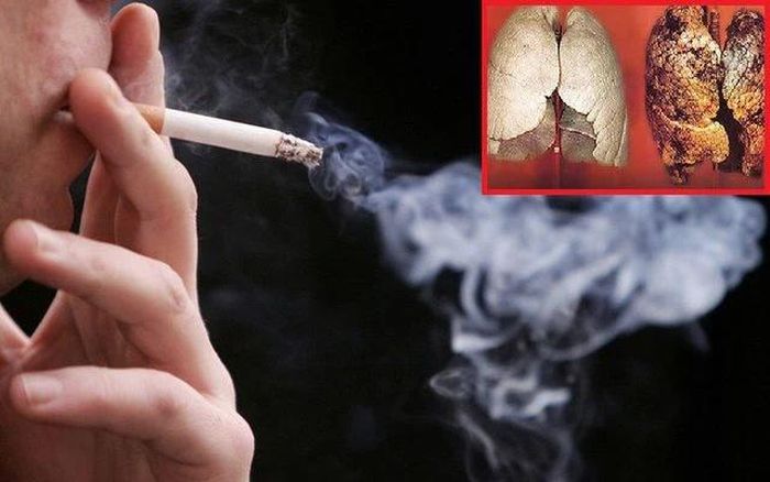90% người mắc ung thư phổi là người hút thuốc lá. Ảnh: Internet