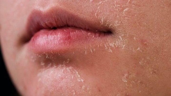 Thời tiết hanh khô của mùa đông khiến làn da dễ bị nứt nẻ, khô ráp. (Ảnh minh họa)