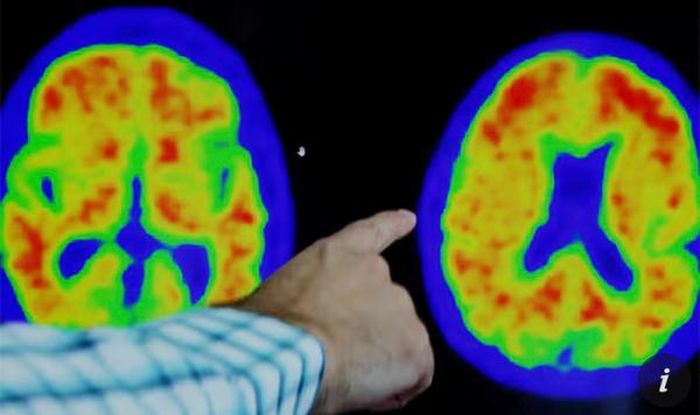 Nghiên cứu chữa bệnh Alzheimer.
