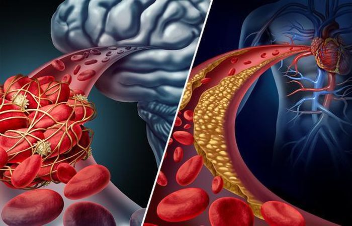 Thời tiết lạnh làm tăng nguy cơ nhồi máu cơ tim và đột quỵ.