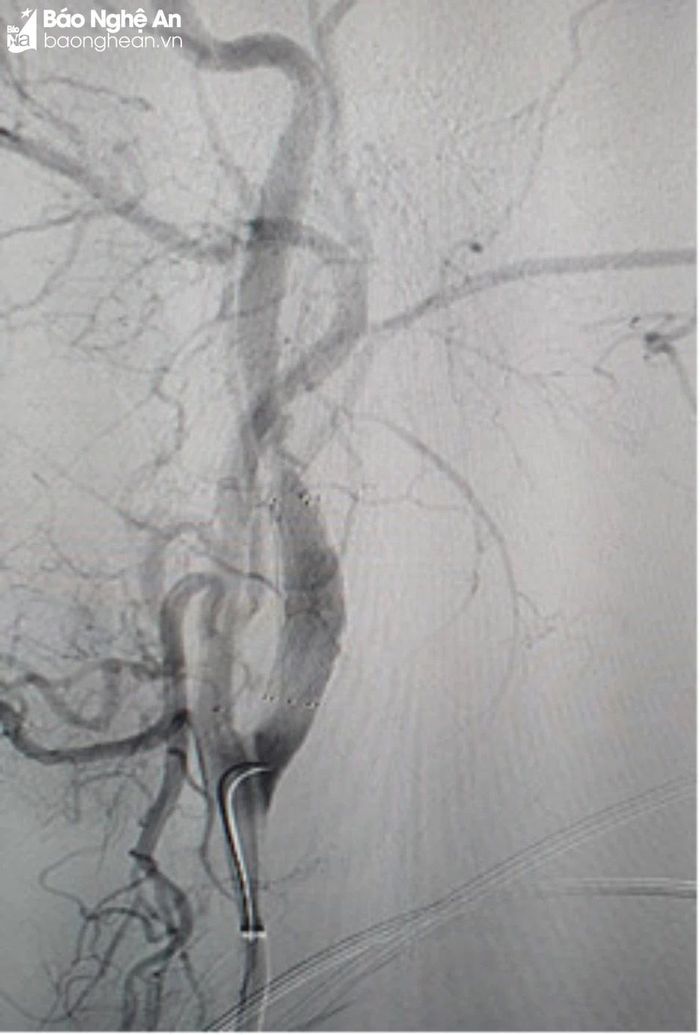  Đặt Stent gốc động mạch cảnh trong phải cho bệnh nhân. Ảnh: Hồ Hà 