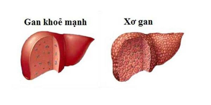 Bệnh xơ gan vẫn có thể hồi phục nếu được phát hiện sớm và người bệnh tuân thủ chặt chẽ phác đồ điều trị của bác sĩ.