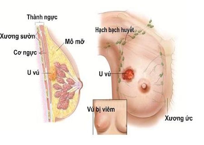 Lao vú có những triệu chứng dễ nhầm với viêm tuyến vú, áp xe vú…