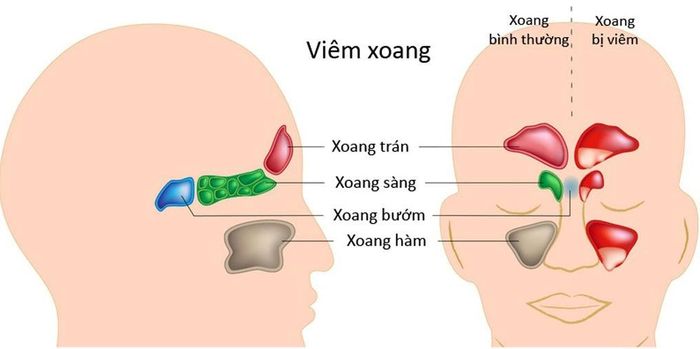 Hình ảnh viêm xoang.