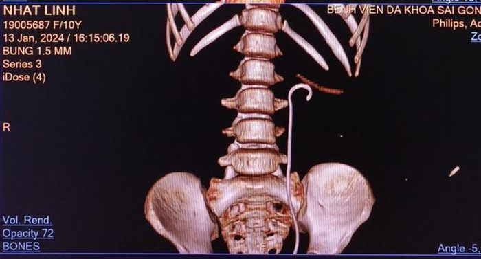 Sau phẫu thuật lấy sỏi qua da đường hầm nhỏ nằm ngửa (vết mổ 8mm)