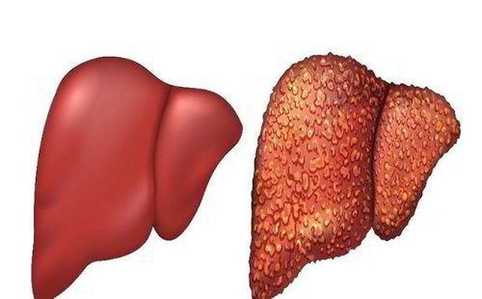 Virus viêm gan B có thể gây ra tổn thương gan, hủy hoại tế bào gan.
