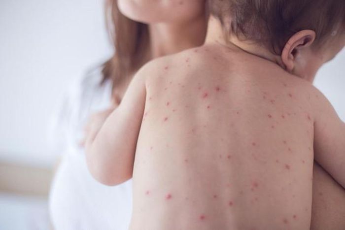 Bệnh xảy ra phần nhiều ở trẻ em, nhưng cũng không ít người lớn mắc thủy đậu.