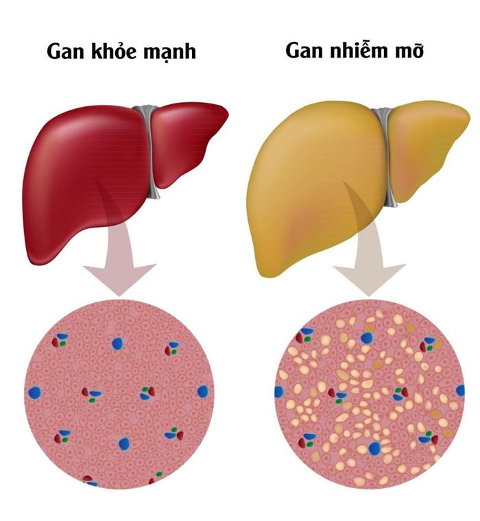 Hình ảnh gan khỏe mạnh và gan nhiễm mỡ.