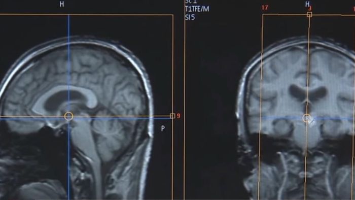 Trong bộ não bị Alzheimer, amyloid liên tục tích tụ cho đến khi nó hình thành những mảng bám gây ra tắc bộ não