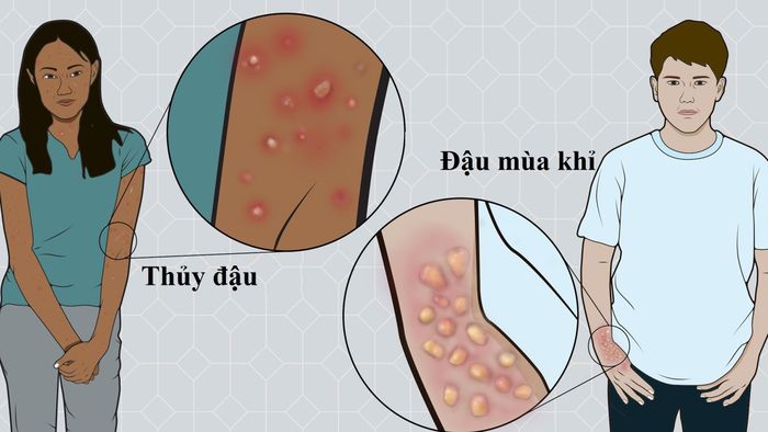  Các nốt phát ban, mụn xuất hiện ở bệnh thủy đậu và đậu mùa khỉ. Ảnh minh họa: The Ohio State University. 