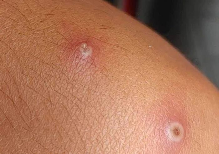 Mụn mủ của bệnh nhân đậu mùa khỉ. Ảnh: CDC Cà Mau.