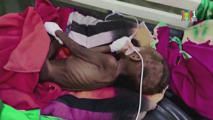 UNICEF cảnh báo 3,7 triệu trẻ em sẽ bị suy dinh dưỡng trầm trọng trong năm nay ở Sudan