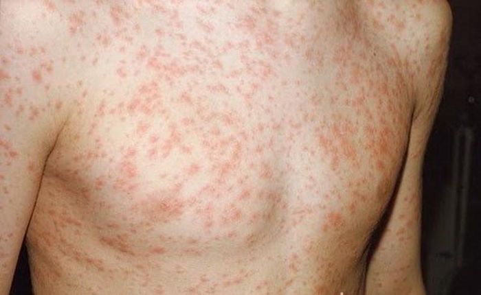  Trẻ mắc sởi thường bị sốt phát ban 