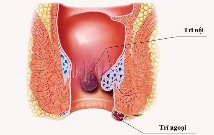  Bệnh trĩ là một trong những bệnh lành tính ở vùng hậu môn. 