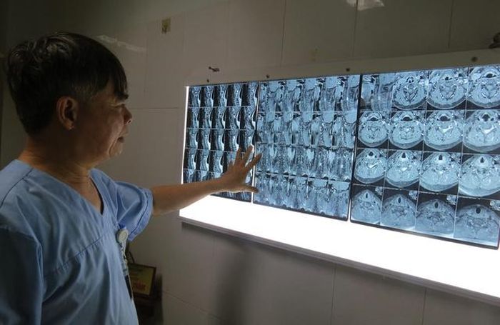 Các bác sĩ đánh giá đây là ca rất nặng và phức tạp khi khối u to, chèn ép gần hết ống sống ngang mức (vùng C5, C6).