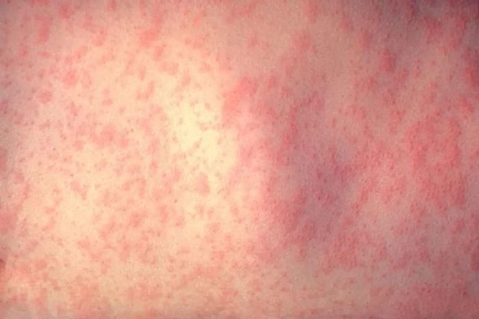 Giai đoạn toàn phát, phát ban sần, mịn như nhung, không có nước.