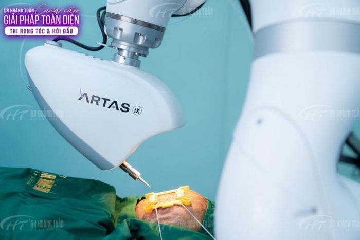 ARTAS IXi là nền tảng cấy ghép tóc thông minh đầu tiên trên thế giới sử dụng công nghệ trí tuệ nhân tạo AI, hệ thống camera phân giải cao và robot tiên tiến.
