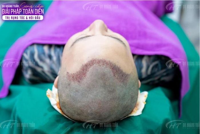 Công nghệ cấy tóc ARTAS iX được chứng nhận hiệu quả và an toàn, ít xâm lấn.