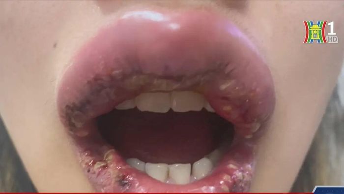 Đã có nhiều người bị biến chứng sau khi làm đẹp ở các cơ sở chui.