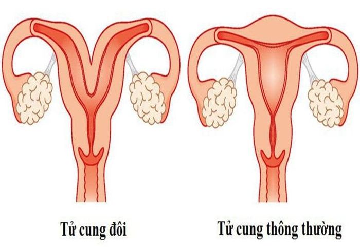 Tử cung đôi là một dị dạng hiếm gặp và ảnh hưởng rất lớn tới khả năng sinh sản của nữ giới.