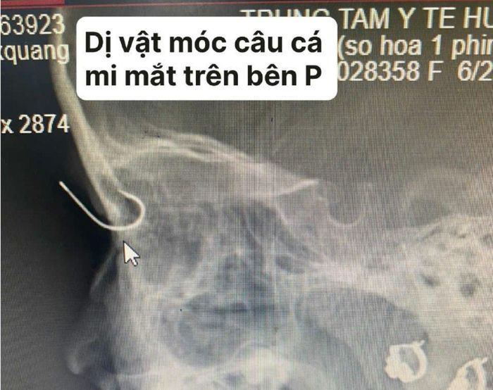 Hình ảnh móc câu xuyên qua mí mắt bệnh nhi trên phim.