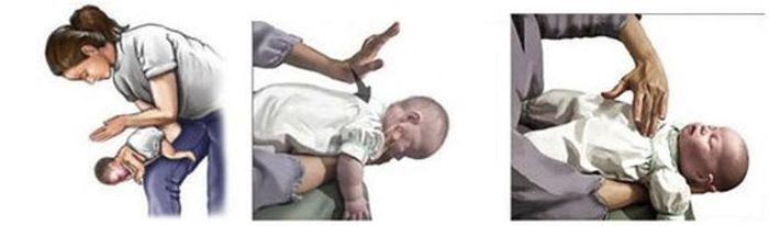 Các biện pháp cấp cứu sặc sữa trẻ sơ sinh. Ảnh: Bệnh viện Nhi TƯ