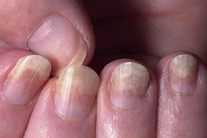 Biểu hiện của móng tay có thể liên quan đến vấn đề tuyến giáp. Ảnh: Getty