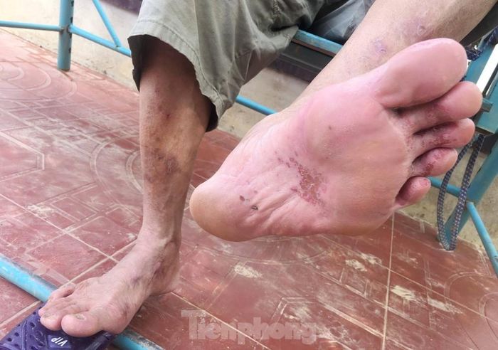 Chân của người dân vùng lũ sau khi nước rút. 