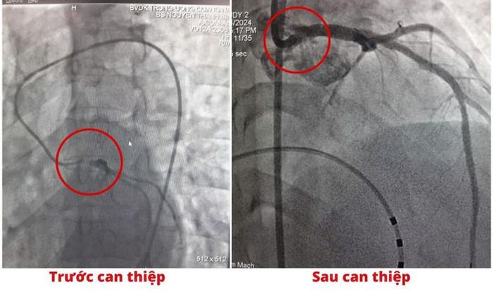 Hình ảnh DSA bệnh nhân tắc thân chung động mạch vành trái và sau can thiệp đã tái thông mạch vành trái (Ảnh: BVCC)