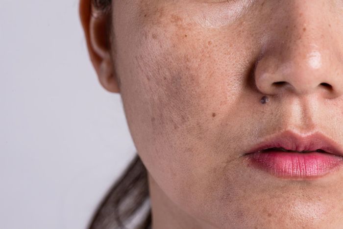 Tăng nồng độ estrogen làm tăng tình trạng nám da khi mang thai và sau sinh.