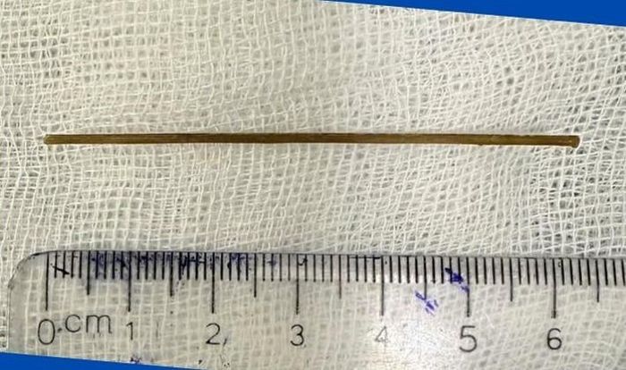  Tăm tre dài hơn 6cm được gắp ra ngoài thành công qua phương pháp nội soi gây mê 