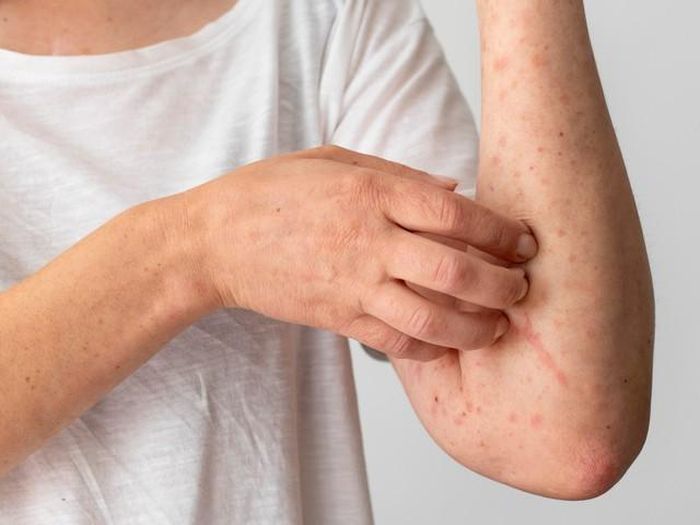 Viêm da có thể có nhiều hình thức khác nhau như sưng, đỏ, ngứa, phồng rộp, phát ban hoặc bị bong da. Ảnh minh họa