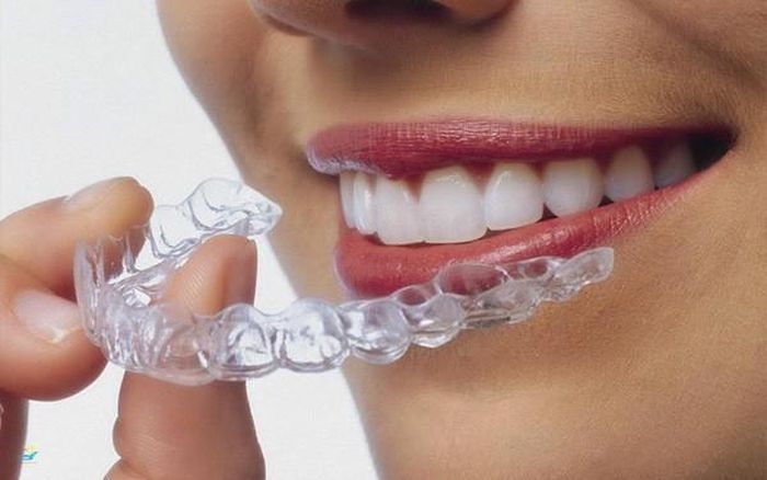 Niềng răng invisalign gần như vô hình, mang đến tự tin cho người điều trị