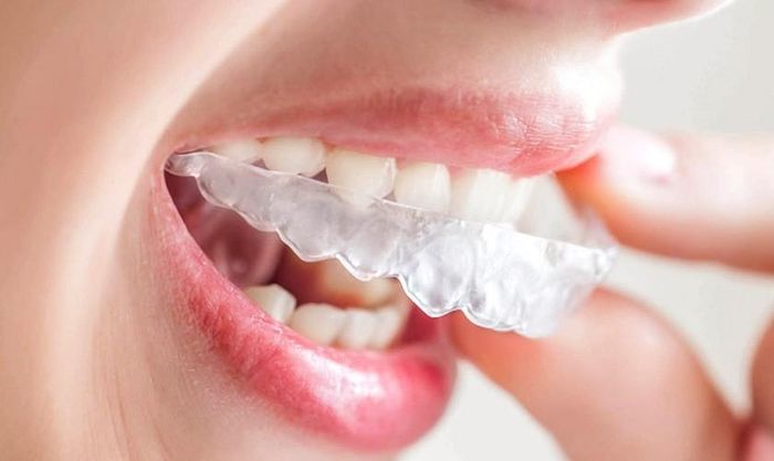 Người điều trị có thể cảm nhận rõ được kết quả niềng răng sau mỗi lần thay khay
