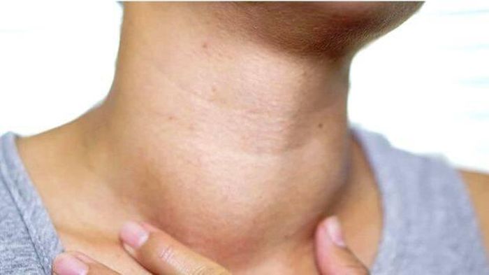 Lao hạch thường biểu hiện bằng tình trạng sưng không đau ở một hoặc nhiều hạch bạch huyết trong nhiều tuần đến nhiều tháng.