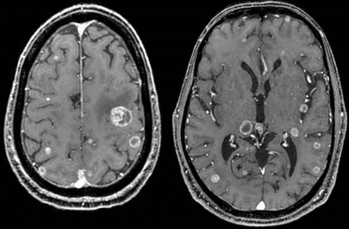 Hình ảnh ung thư não trên CT Scan. Ảnh: Sưu tầm
