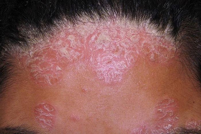 Vảy nến da đầu nếu không được điều trị sớm sẽ tiến triển nặng hơn dẫn đến gàu và rụng tóc không mọc lại.