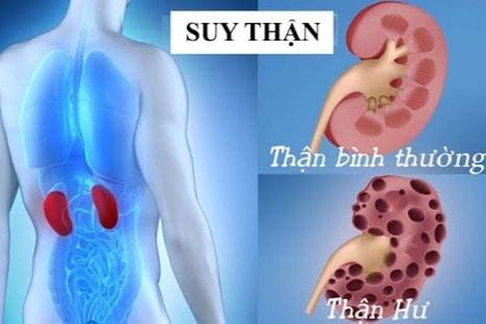 Ở giai đoạn đầu, bệnh thận thường tiến triển âm thầm. Ảnh: H.T