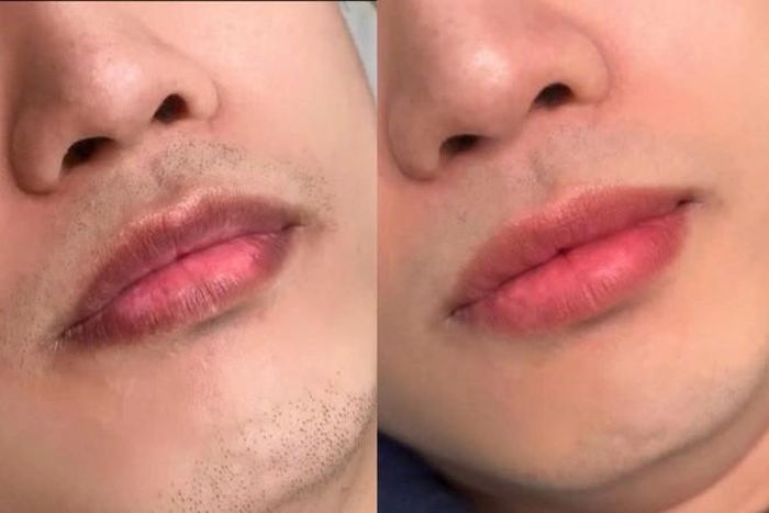 Hình ảnh trước và sau khi nam giới phun môi dành cho nam
