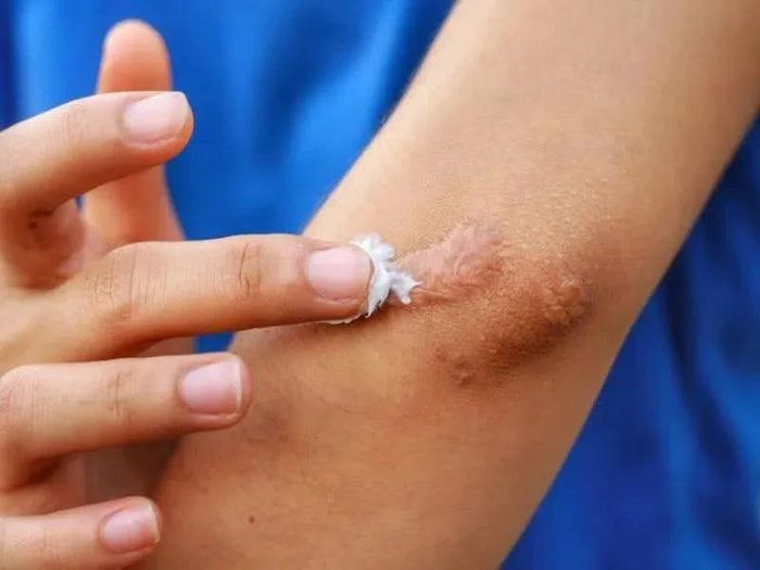 Gel Promed được giới thiệu trên các website là gel ngừa sẹo, sát khuẩn và tái tạo tế bào da. (Ảnh minh họa)
