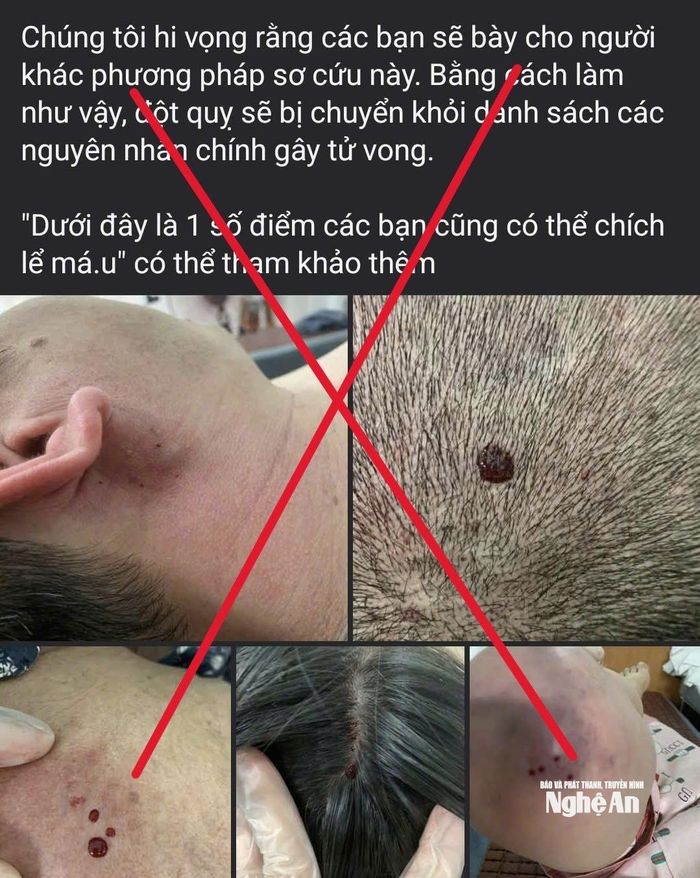 Một phương pháp sơ cứu đột quỵ sai cách được lan truyền trên mạng.