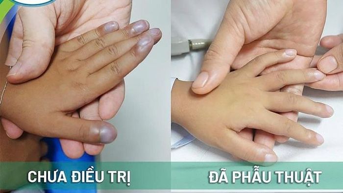 Bàn tay bệnh nhi đã trở về bình thường sau phẫu thuật bệnh tim bẩm sinh. 