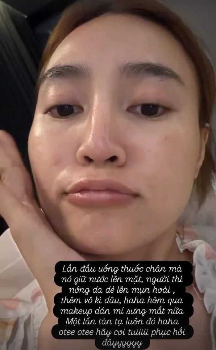 Ninh Dương Lan Ngọc chia sẻ về tình trạng gặp phải khi uống thuốc điều trị chấn thương. (Ảnh FBNV)